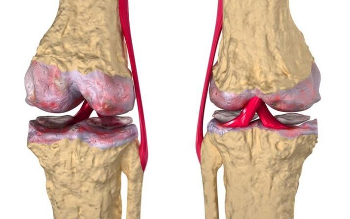 Arthrose des Kniegelenks.