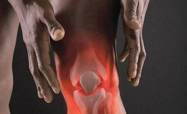 Arthrose geht mit einem entzündlichen Prozess im Kniegelenk einher.