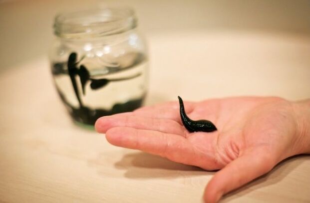 Medizinische Blutegel bei Arthrose der Kniegelenke können Schwellungen reduzieren, Entzündungen lindern und Schmerzen lindern.